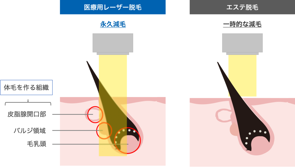 ♡メンズ脱毛の秘密♡全裸で…脱毛中に勃起してしまう？