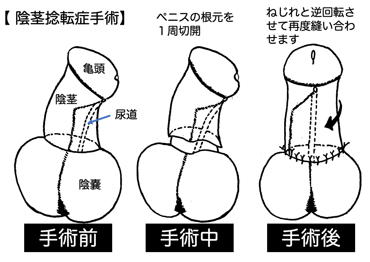 ペニスの曲がり】ペニスが曲がっているのはなぜなのか - TENGAヘルスケア