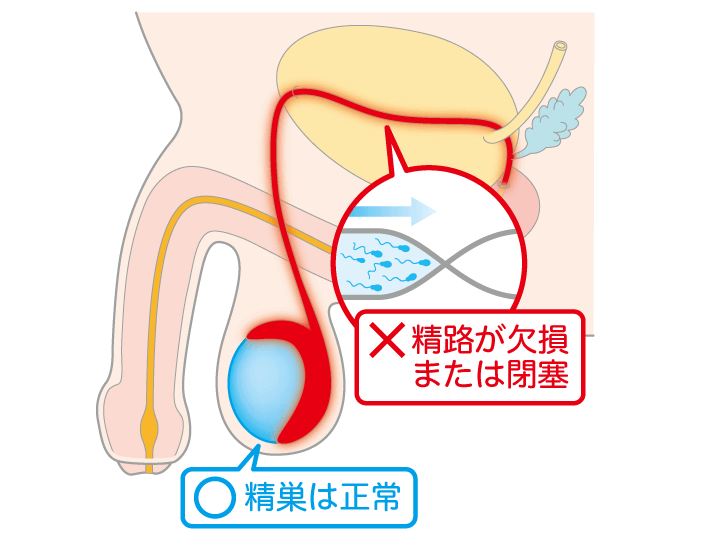 意外に多い男性不妊の原因とおすすめの漢方処方は?｜笠原友子