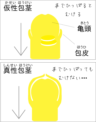 ズルむけーるバンド - 男性サポートグッズ