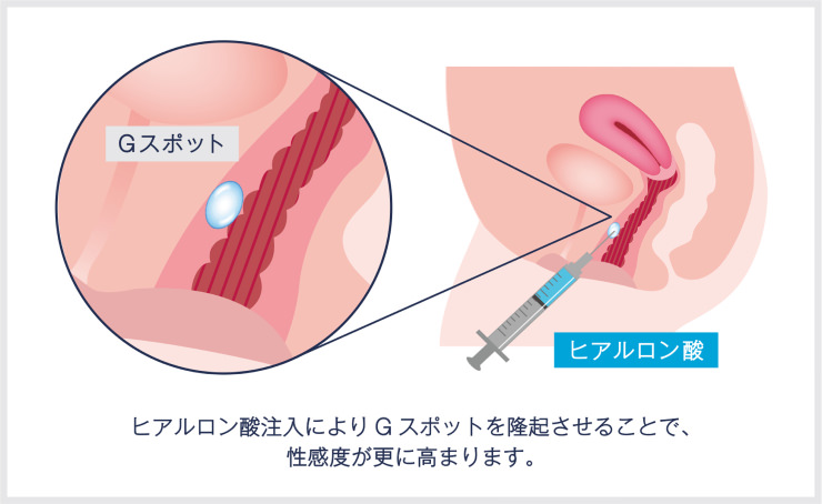 Gスポット開発セット 4,500円 | 大人のおもちゃとアダルトグッズ通販 セール